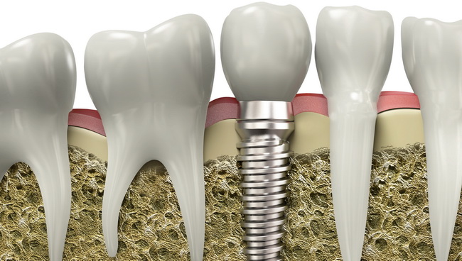 Dentist Montenegro Implantati