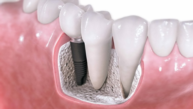 Dentist Montenegro Implantati